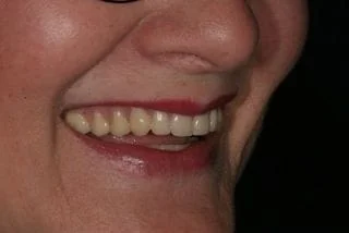 My new dentures are perfect!