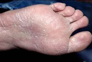 <strong>
</picture>Athlete's Foot</strong> <p>This shows the bottom of a foot with athlete’s foot.  The skin is dry and cracked.</p>