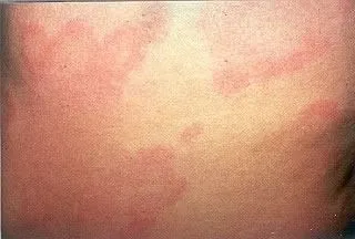 <strong>
</picture>Hives on the Back</strong> <ul><li>Hives is an itchy rash. </li><li>The shapes of hives vary. Sizes of hives vary from ½ inch to several inches across. </li><li>Hives may disappear in one area and then reappear somewhere else, over the course of several hours. </li></ul>