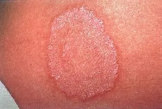 <strong>
</picture>Ringworm Rash on Arm</strong> <p>This is a picture of ringworm. The area is round and pink. It has a raised, rough scaly border. The ring slowly grows in size. It is often slightly itchy.</p><p>This is caused by a fungus, not a worm. It can be passed from person to person.  If you notice a rash like this, contact your doctor for treatment.</p>