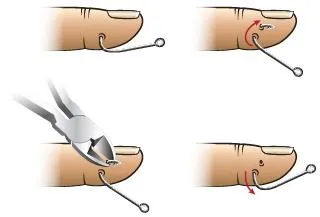 <strong>
</picture>First Aid - Removing a Fishhook</strong> <p>This method of fishhook removal is sometimes called the <strong>Advance and Cut Method.</strong></p><p>There are four steps in removing a fishhook:</p><ol><li><strong>Step 1. </strong>Using pliers (or needle drivers) firmly grasp the hook.</li><li><strong>Step 2. </strong>Push (advance) the hook until the tip of the hook pops out through the skin.</li><li><strong>Step 3. </strong>Cut off the tip of the hook and the barb.</li><li><strong>Step 4. </strong>Back out the hook out.</li></ol><p><em>Important Note: </em></p><ul><li>Use these instructions when you can't get into see a doctor right away. Most of the time, it is best to have a doctor (or other health care provider) remove a fishhook.</li><li>The hook in this drawing has only a single barb at the tip, so the tip of the hook (with the barb) can be cut off and the hook pulled backwards through the skin.</li><li>Some hooks can have more than one barb. In such cases, it is better to cut off the ring at the bottom of the hook and push the hook all of the way through the skin.</li></ul>