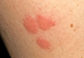 <strong>
</picture>Bed Bug Bite</strong> <p>This is what a bed bug bite looks like.  It can take a few days for the bites to appear after a bed bug bites you.  The bites are usually itchy and often have a burning feeling. Try not to scratch and break the skin because this can cause an infection.</p>