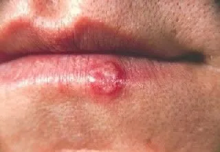 <strong>
</picture>Cold Sore of Lower Lip</strong> <p>This shows a cold sore on the lip. Cold sores are caused by the Herpes simplex virus. This cold sore has been visible for two days.</p>