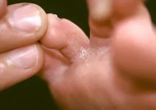 <strong>
</picture>Athlete's Foot between Toes</strong> <p>Athlete’s foot is often located between the toes.  The skin is dry and cracked.</p>