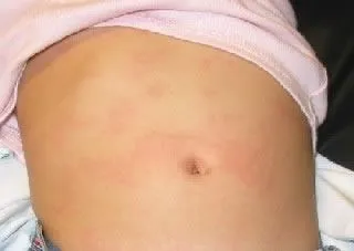 <strong>
</picture>Hives on the Abdomen</strong> <ul><li>Hives is an itchy rash. </li><li>The shapes of hives vary. Sizes of hives vary from ½ inch to several inches across. </li><li>Hives may disappear in one area and then reappear somewhere else, over the course of several hours. </li></ul>