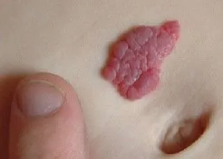 <strong>
</picture>Strawberry Hemangioma - Abdomen</strong> <p>This photo shows a Strawberry Hemangioma near the navel. A hemangioma is a cluster of blood vessels that cause non-cancerous growths.</p>