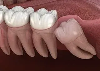 illustration of impacted wisdom tooth in mouth, oral surgery Beverly Hills, MI oral surgeon