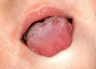 <strong>
</picture>Hand-Foot-and-Mouth Disease (tongue)</strong> <p>This is what hand-foot-and-mouth disease looks like on the tongue.  There are sores or blisters on the tongue.  Make sure to wash hands often to prevent the spread of the disease.</p>