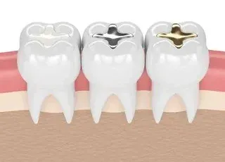 illustration of three teeth each with a different type of filling in it - dentist Bradenton, FL dental fillings