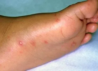 <strong>
</picture>Hand-Foot-and-Mouth Disease (foot)</strong> <p>This shows the sores or blisters from hand-foot-and-mouth disease on the foot.  Make sure to wash hands often to prevent the spread of the disease.</p>