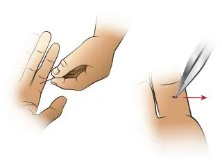 <strong>
</picture>First Aid - Removing a Splinter</strong> <p>You can remove splinters, larger slivers, and thorns with a <strong>needle</strong> and <strong>tweezers.</strong> Check the tweezers before you start, to be certain the ends meet exactly. If they do not, bend them until they do. Sterilize the tools with rubbing alcohol or a flame. </p><p><strong>Clean the skin</strong> around the sliver carefully with rubbing alcohol before trying to remove it. Be careful not to push the splinter in deeper. If you don't have rubbing alcohol, use soap and water, but don't soak the area if splinter is wood. Reason: soaking can cause swelling of the splinter. </p><p><strong>Remove the splinter:</strong></p><ul><li><strong>Step 1: </strong>Use the needle to completely expose the large end of the sliver. Use good lighting. A magnifying glass may help.</li><li><strong>Step 2:</strong> Then grasp the end of the sliver firmly with the tweezers and pull it out at the same angle that it went in. Getting a good grip the first time is very important for slivers that go in perpendicular to the skin or those trapped under the fingernail. </li></ul>