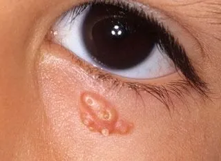 <strong>
</picture>Molluscum Contagiosum - Eye</strong> <p>This shows an eye with an infection from the molluscum contagiosum virus. The growths are pink, white or pearly-colored. They are firm, small and raised with a dimple in the middle.</p>