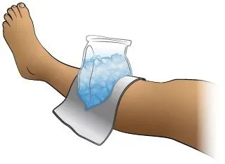 <strong>
</picture>First Aid - Cold Pack for Minor Leg Injury</strong> <ul><li>Apply a cold pack or an ice bag (wrapped in a moist towel) to the area for 20 minutes. Repeat in 1 hour, then every 4 hours while awake.</li></ul>