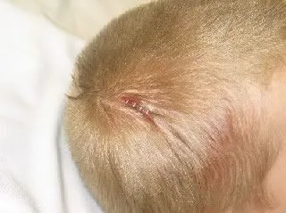 <strong>
</picture>Laceration - Scalp (After Staples)</strong> <p>This photo shows a scalp laceration after it has been closed with 4 metal medical staples. </p>