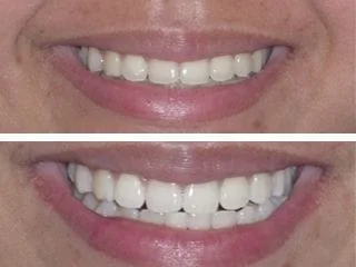 before and after image of results of professional teeth whitening North York, ON dentist