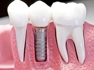 Dental Implants Image