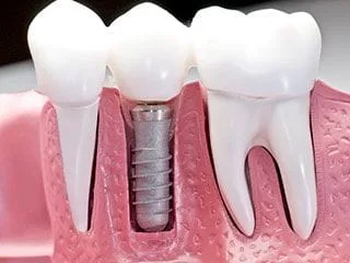 Dental Implants Stockton