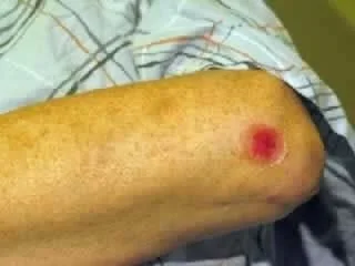 abrasion on elbow