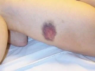 bruise on thigh