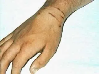 <strong>
</picture>Scratches from a Cat</strong> <p>The photo shows 3-4 parallel scratches on the wrist caused by a cat.</p><p><em>First Aid Care Advice:</em></p><ul><li>Wash the scratches with soap and water.</li><li>Apply an antibiotic ointment twice daily.</li><li>Watch closely for signs of infection, especially the first 1-3 days. Signs of infection include fever, redness or tenderness or pus at the scratch site.</li></ul>