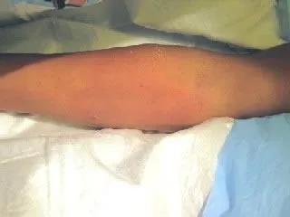 <strong>
</picture>Burn - First Degree</strong> <p>The photo shows a 6 inch (15 cm) wide area of mild redness without blistering on the forearm. This thermal burn was caused by spilled hot water.</p><p><em>First Aid Care Advice:</em></p><ul><li>Put the burned part in cold tap water right away or pour cold water over it for 10 minutes or cover with a cold wet washcloth.</li><li>Reason: this lessens the depth of the burn and relieves pain.</li></ul>