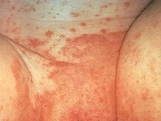 <strong>
</picture>Diaper Rash</strong> <p>This photo shows a red diaper rash in the area under the diaper. </p><p>Any diaper rash that lasts longer than a couple days can become infected with yeast. Note the red spots outside the main area of redness. </p><p>If a yeast infection is suspected, clotrimazole cream (such as Lotrimin; over-the-counter) should be applied 4 times per day.</p>