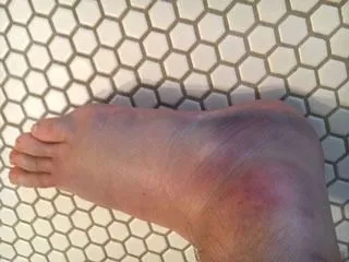 <strong>
</picture>Ankle Sprain</strong> <p>This shows a sprained ankle. The ankle and foot are swollen because they were not wrapped with an elastic bandage right after the injury.</p><p><em>First Aid Care Advice for Ankle Sprain:</em></p><ul><li>Wrap with a snug elastic bandage. </li><li>Apply an ice pack (crushed ice in a plastic bag covered with a towel) to reduce swelling and pain.</li></ul>