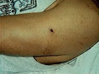 <strong>
</picture>Puncture Wound - BB Gun</strong> <p>This photo shows a puncture wound from a BB gun in the upper arm. Note the small hole in the arm where the BB struck and entered the skin.</p>