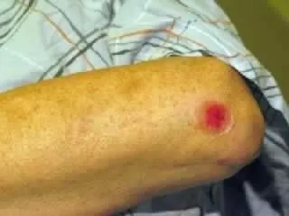 <strong>
</picture>Abrasion on Elbow</strong> <p>This picture shows a shallow scrape on the left elbow. </p><p><em>First Aid Care Advice for Minor Scrape:</em></p><ul><li>Apply direct pressure for 10 minutes to stop any bleeding.</li><li>Wash the area with soap and water.</li><li>Gently scrub out any dirt with a washcloth.</li><li>Apply an antibiotic ointment, covered by an adhesive bandage or dressing. Change daily.</li><li>Another option is to use a Liquid Skin Bandage that only needs to be applied once. Avoid ointments with this.</li></ul>