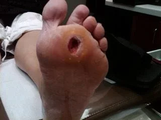  Severe Diabetic Foot Ulcer