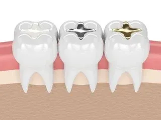 illustration of three teeth each with a different type of dental filling, dentist Sherman Oaks, CA dental filling
