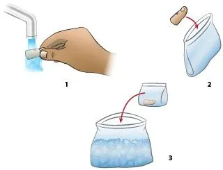 <strong>
</picture>First Aid - Amputated Finger or Toe - Transport</strong> <ul><li><strong>Step 1</strong>: Briefly rinse amputated part with water (to remove any dirt)</li><li><strong>Step 2</strong>: Place amputated part in plastic bag (to protect and keep clean)</li><li><strong>Step 3</strong>: Place plastic bag containing the part in a container of ice (to keep cool and preserve tissue).</li></ul><p><em>Note</em>: Take patient and amputated part to emergency department immediately.</p>