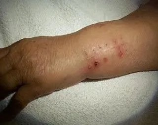 <strong>
</picture>Wound Infection - Suture Site</strong> <p>There is a pimple where a stitch comes through the skin. The pimple suggests a low-grade infection.</p>