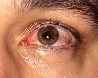 <strong>
</picture>Conjunctivitis - Viral (Pink Eye)</strong> <p>This patient had pink-eye, also known as viral conjunctivitis. </p><p>Symptoms can include: </p><ul><li>Mild discomfort, burning or irritation of the eye(s)</li><li>White portions of the eye(s) may or may not be pink or red </li><li>Eyelids may be puffy and irritated </li><li>Tearing </li></ul>