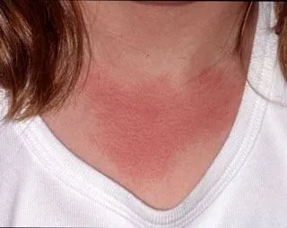 <strong>
</picture>Sunburn - First Degree</strong> <p>This shows a first-degree sunburn on the chest.  It is red without blistering.</p>