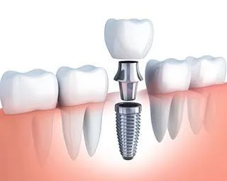 Implant