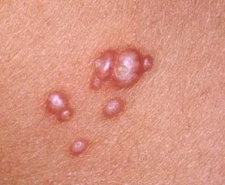 <strong>
</picture>Molluscum Contagiosum</strong> <p>This shows an infection from the molluscum contagiosum virus. Molluscum is sometimes called a "water wart." The growths are pink, white or pearly-colored. They are firm, small and raised with a dimple in the middle.</p>