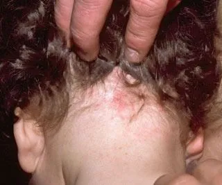 <strong>
</picture>Head Lice Reaction</strong> <p>This shows an allergic reaction to the saliva of a louse (a louse is one lice).  It makes the skin itchy and red.</p>