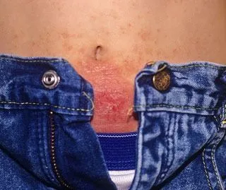 <strong>
</picture>Nickel Allergy Rash - Abdomen</strong> <p>This shows a rash that was caused from the skin touching the snap on the jeans.  This person is allergic to the nickel in the snap. The area is red and crusty.</p>