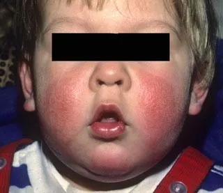 <strong>
</picture>Eczema-Child</strong> <p>This is how eczema can appear on the cheeks of a child. The skin is red, dry, cracked and swollen. Your child may find it itchy.</p>