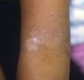 <strong>
</picture>Eczema - Teen</strong> <p>This shows eczema in the elbow crease of a teen.  The skin is dry and may be itchy. It also shows loss of skin pigment (color), which may happen in people with dark skin. Eczema can cause the skin color to be darker or lighter.</p>