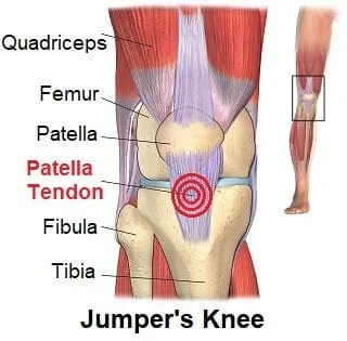 jumpers knee