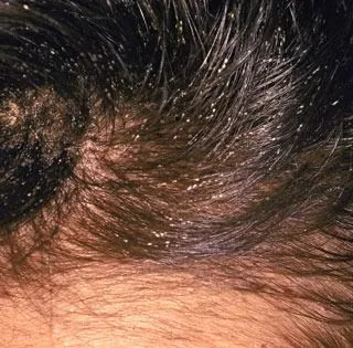 <strong>
</picture>Head Lice - Nits</strong> <p>This shows head lice nits in the hair.  Nits are the eggs of head lice which stick to the hair.</p>