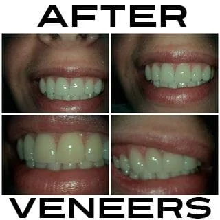 After Veneers