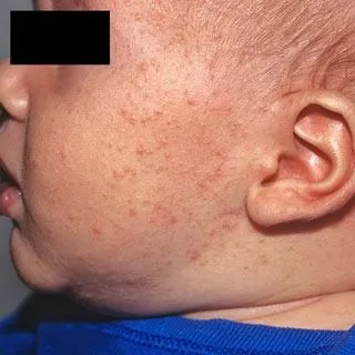 <strong>
</picture>Baby Acne</strong> <p>This shows baby acne on the cheeks and side of the face.  There are red and white raised bumps.</p>