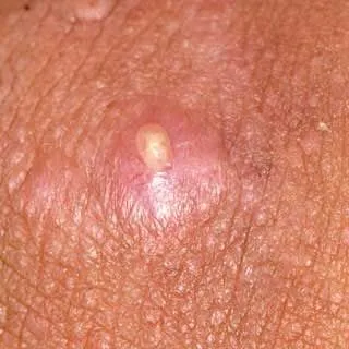 <strong>
</picture>Boil</strong> <p><strong>Boil.</strong> A boil is an infection of a hair follicle. It starts as a red lump and quickly fills with pus.  As it grows, it becomes more painful. This photo shows the pus-filled center of the boil. A doctor can tell if it needs to be drained and when to do so.</p>