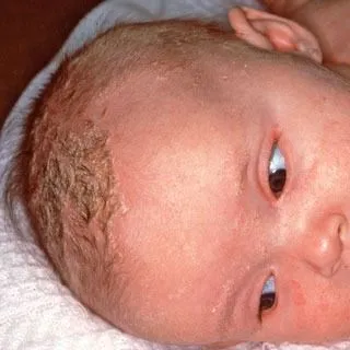 <strong>
</picture>Cradle Cap</strong> <p>This shows a baby with cradle cap on the eyebrows and eyelids. Cradle cap looks oily, yellow, scaly and crusty.</p>