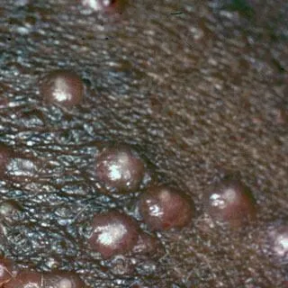 <strong>
</picture>Molluscum</strong> <p>This shows an infection from the molluscum contagiosum virus. Molluscum is sometimes called a "water wart." The growths are pink, white or pearly-colored. They are firm, small and raised with a dimple in the middle.</p>