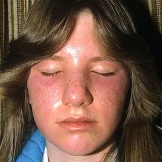 <strong>
</picture>Sunburn - Second Degree</strong> <p>This shows a second degree burn on the face.  The area is red, raised and blistered.</p>