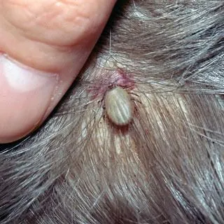 <strong>
</picture>Tick on Scalp</strong> <p>This shows a tick feeding on the scalp.</p>